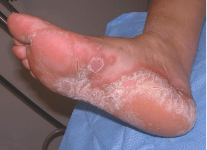 Determine the fungus of the foot