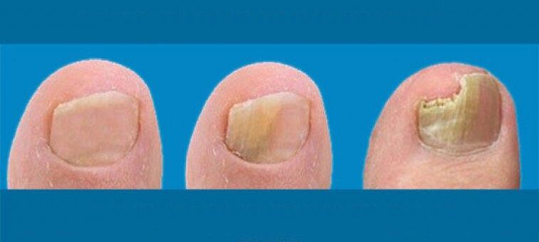 Process of developing nail fungus