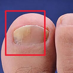 Mycosis or nail sponge
