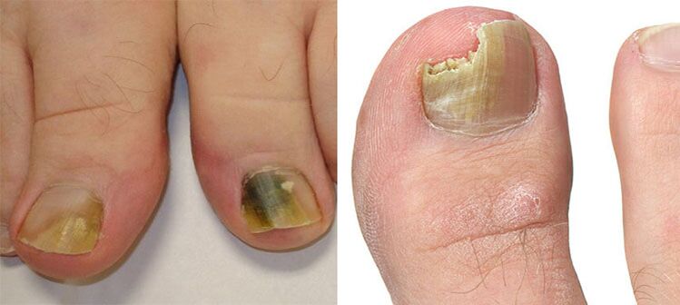 Onychomycosis - Destroying nails with a sponge