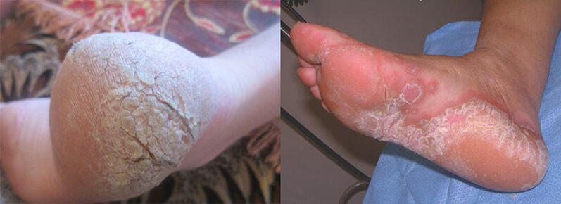 The legs affected by the fungus