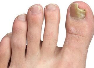 Symptoms of nail fungus