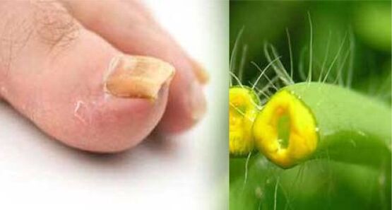 herb celandine for toenail fungus
