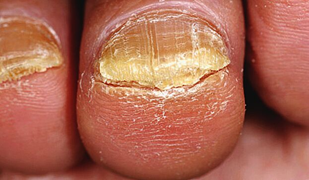 advanced toenail fungus