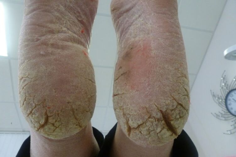 Deep cracks on the skin of the feet with advanced forms of fungus
