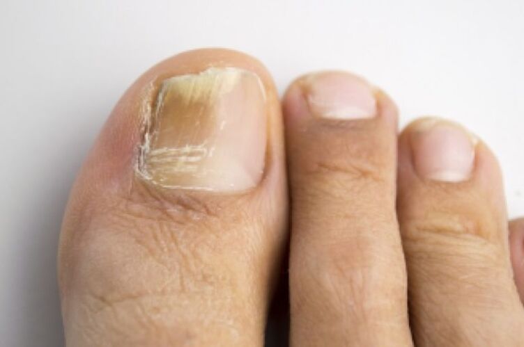 Fungal infection of the toenails