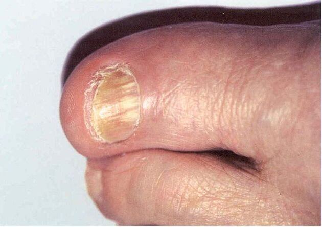 Onychomycosis - a fungal infection of the toenails