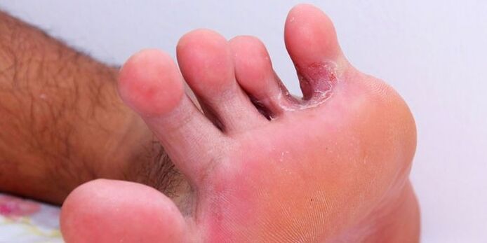 fungus between the toes