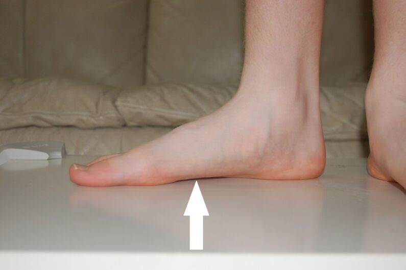 cause of flat feet