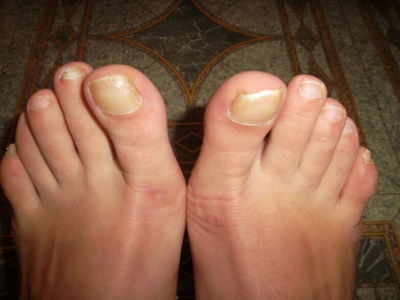 thumb fungus