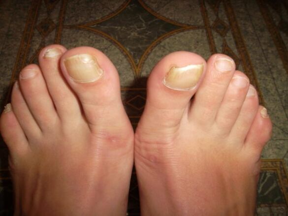 Fungal infection of the nails of the big toes