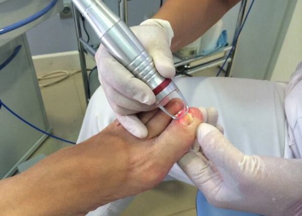 Laser treatment of toenail fungus