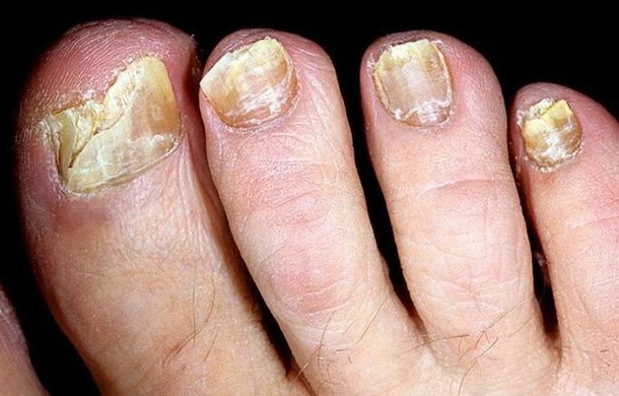 Fungus on the toenails in an advanced stage, requiring complex treatment