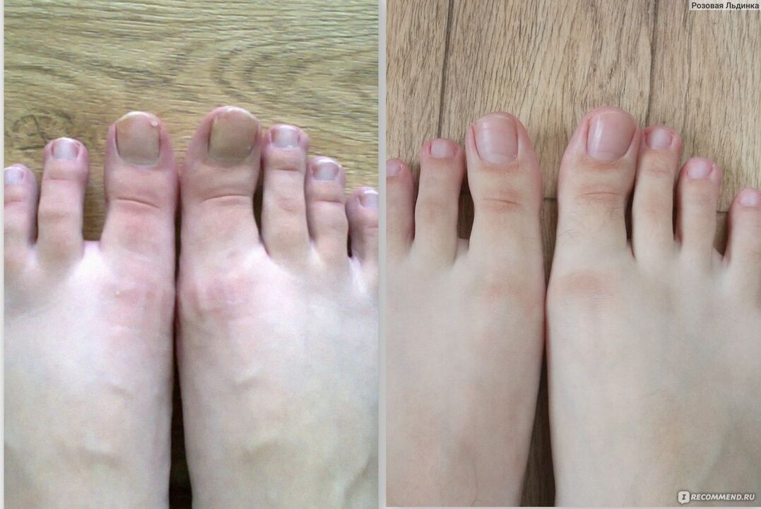 before and after treatment of the fungus with Fungostop Plus cream